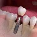 How Long do Dental Implants Last?