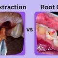 Root Canal vs Tooth Extraction: Which Treatment is Better?