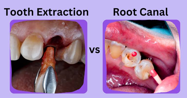 Root Canal vs Tooth Extraction