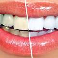 How Much Does Teeth Whitening Cost in Bangalore?