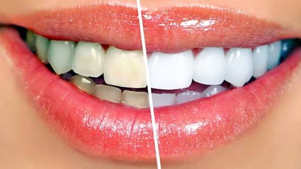 Teeth Whitening