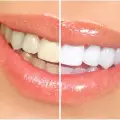 Is Teeth Whitening Safe? Benefits, Risks and Side Effects Explained